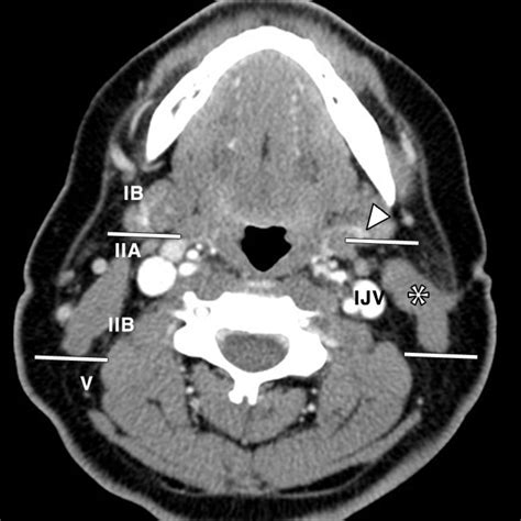 Neck Ct Scan Multiple Necrotic Cervical Lymph Nodes The Biggest Can