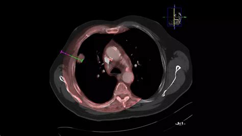 Philips - EmboGuide - Embolization guidance