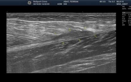 Rotura muscular del gemelo interno o Tennis Leg