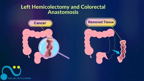 Image result for Colon Cancer Surgery Procedure