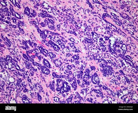Wilms Tumor or Nephroblastoma of a Childs Kidney Viewed at 200x Magnification with Hematoxylin ...