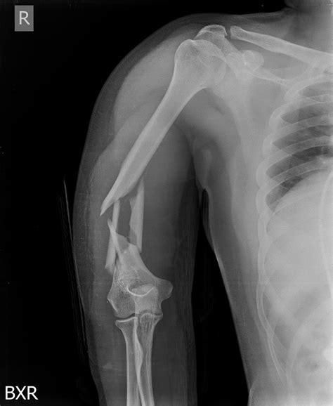 Humeral Shaft Fractures - Trauma - Orthobullets