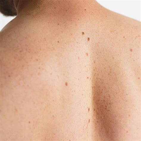 स्किन बायोप्सी क्या है?| Skin Biopsy in Hindi