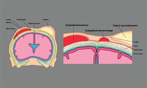 Subgaleal Hematoma Ultrasound