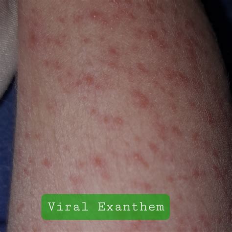 Viral Rash - Emdoc Health