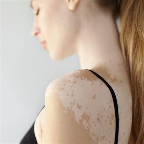 Dr. N Kummar MBBS MD (SKIN) | best skin doctor in greater noida