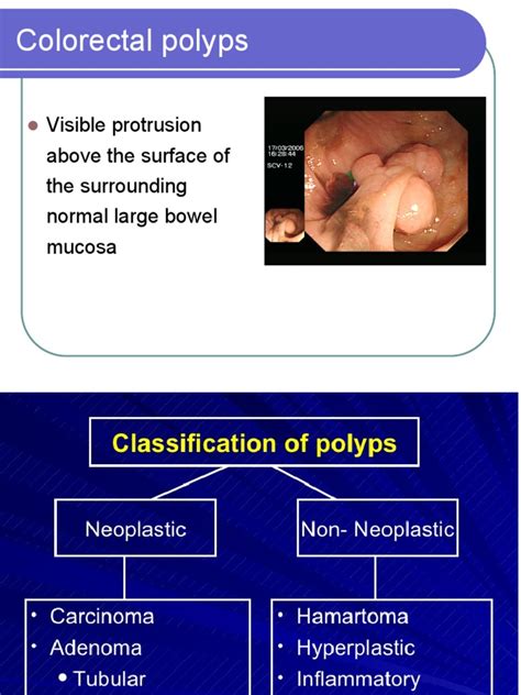 A Comprehensive Overview of Colorectal Polyps: Classification, Types ...