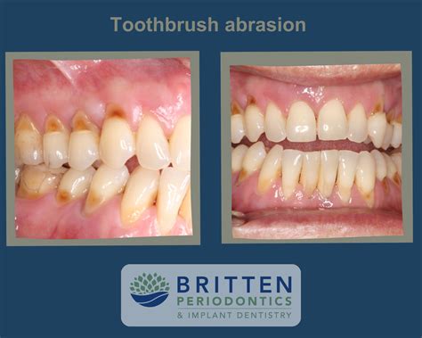 Understanding Toothbrush Abrasion - Britten Perio