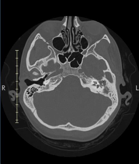 thought this might be of interest. CT scan of the temperal base of the skull showing complete ...