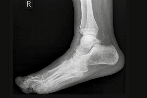 Optionen der inneren Fixation bei Charcot-Arthropathie - Orthopädie ...