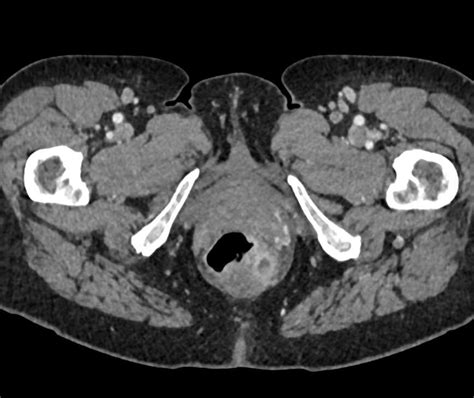 Bildergebnis für ruptured abscess on colon