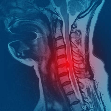 Rodrigo Pedrosa | Hernia Discal Cervical