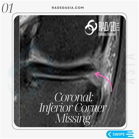 MENISCUS TEAR MRI KNEE: MISSING MENISCI WHAT TO LOOK FOR - Radedasia