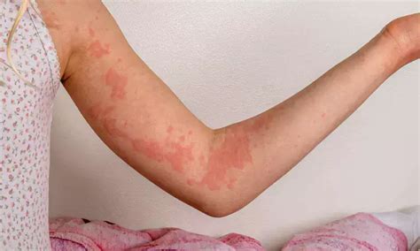 FDA Approves Oral Remibrutinib as First BTK Inhibitor for Chronic ...