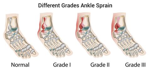 Sprained Ankle Treatment in Sydney (A Guide To Help You With Your Ankle Sprain)