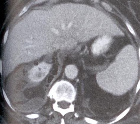 肾血管平滑肌脂肪瘤的CT诊断