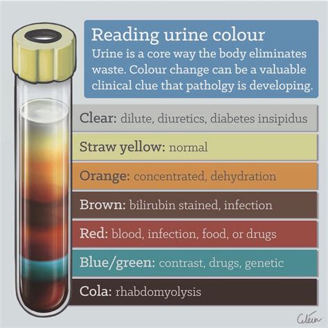 Urine Color Cirrhosis