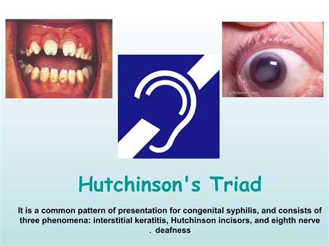 Ophthalmology Eponyms II ! | PPT