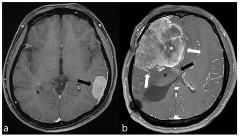 Predicting Histologic Grade of Meningiomas Using a Combined Model of ...
