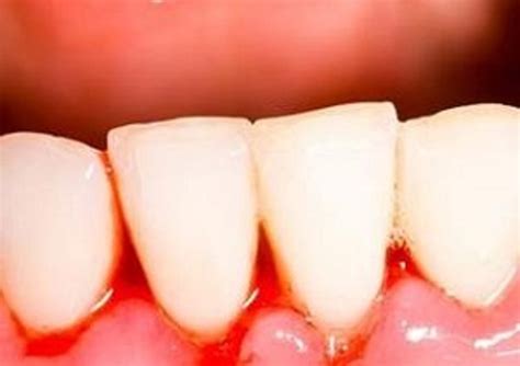牙龈容易出血是什么原因引起的-牙龈容易出血是什么原因引起的,牙龈,容易,出血,是,什么,原因,引起 - 早旭经验网