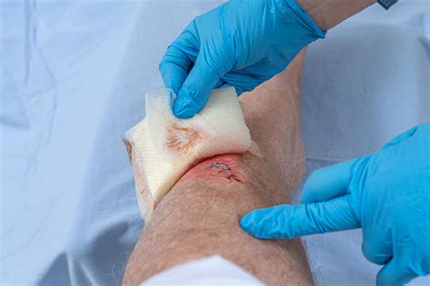 Think You Know Slough Wounds? - Net Health