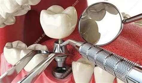 山西省齿科医院价格表公布:种植牙/牙齿矫正/补牙费用不贵,牙齿对比照片-8682赴韩整形网