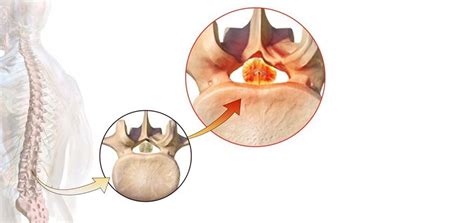 Image result for Spinal Fixation