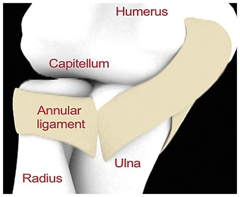 Reduction of Pulled Elbow | NEJM