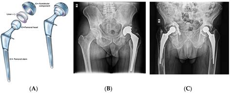 Total Hip Arthroplasty