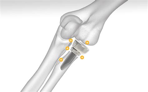 Prosthetic Radial Head 的图像结果