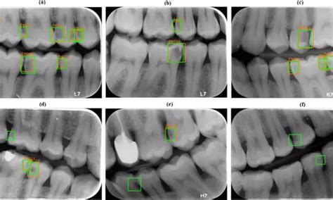 Artificial intelligence may help detect proximal caries on bitewing x ...