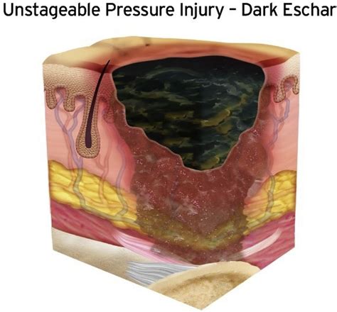 Unstageable Pressure Injuries - Critical Care Nursing Clinics