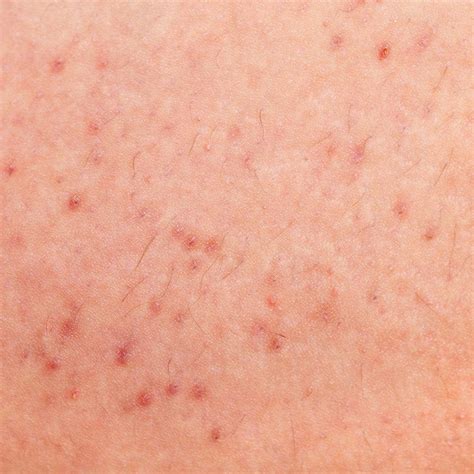 Take on Your Worst Shaving Issues: Razor Burn vs. Ingrown Hairs vs. Ra ...