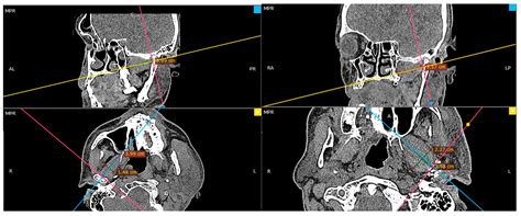 Lateral Pterygoid Muscle Alteration in Patients Treated Surgically Due to Mandibular Head Fractures