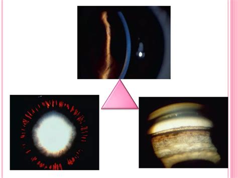 Pigment dispersion syndrome | PPTX