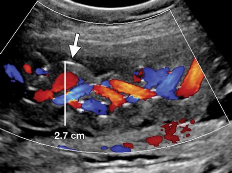 Bildergebnis für umbilical cord abnormalities ultrasound