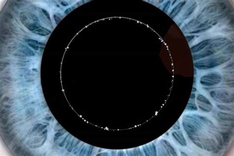 Neue Laser-Technik für Graue-Star-Operationen