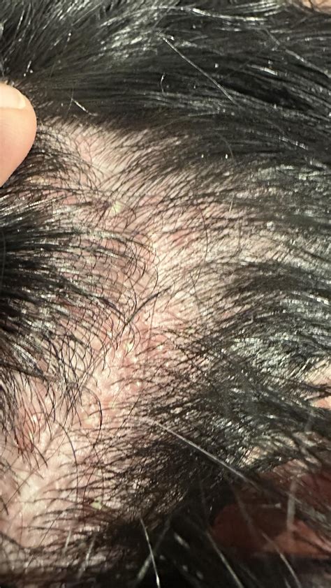 Painful bumps over most of my scalp, what is this? Popped up 2 days ago and felt tender to touch ...