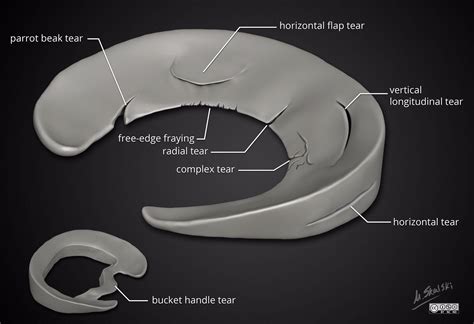 Meniscal tear types. Illustration by Dr. Matt Skalski (Twitter @docskalski) | Meniscal tear ...