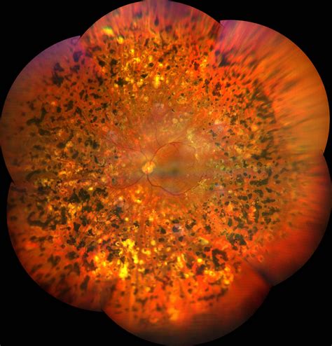 Proliferative Diabetic Retinopathy - Andrea Cusumano