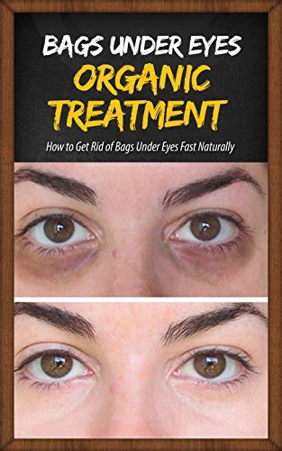 Bags Under Eyes Organic Treatment : How to Get Rid of Bags Under Eyes ...