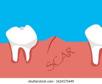 Image result for Tooth Extraction Scar Tissue