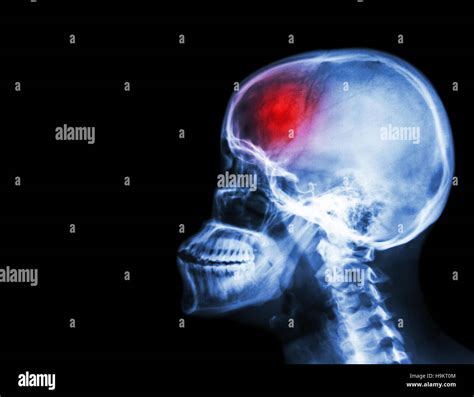 Stroke . film x-ray skull and cervical spine lateral view and stroke ...