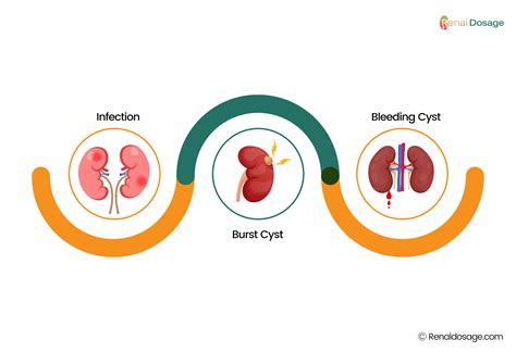 RenalDosage - What is Kidney cyst? Size, Symptoms, Cause, and Treatments