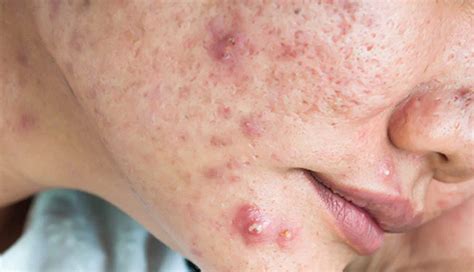 Understanding Acne: Causes and 10 Foods You Should Avoid - lifeberrys.com