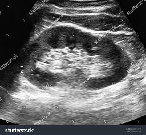 Healthy Kidney Ultrasound