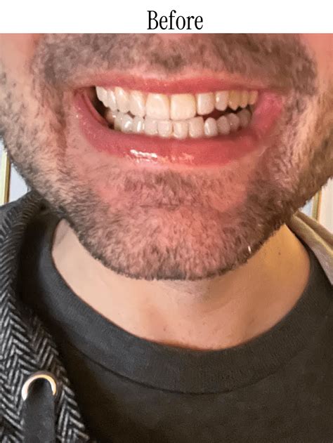 Image result for Best Toothpaste for White Teeth