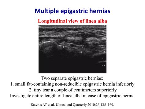 Ultrasound of groin & anterior abdominal wall hernias | PPTX