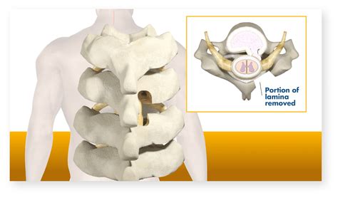Cervical Laminectomy