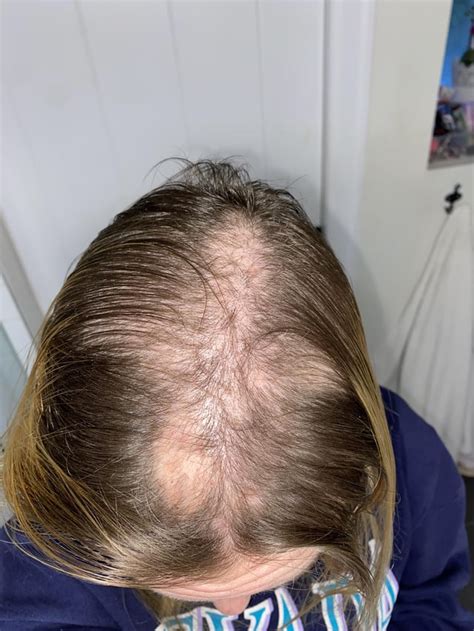 Image result for Diffuse Alopecia